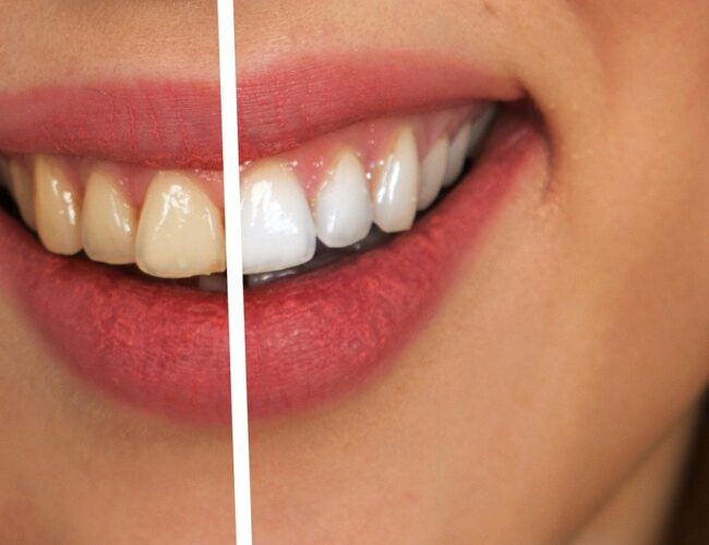 Dents blanches magiques, que faire ?